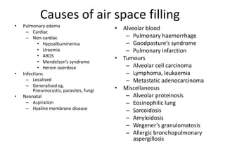 Causes of air space filling
•   Pulmonary edema
                                          • Alveolar blood
      – Cardiac
      – Non-cardiac                          – Pulmonary haemorrhage
            • Hypoalbuminemia                – Goodpasture’s syndrome
            • Uraemia                        – Pulmonary infarction
            • ARDS
                                          • Tumours
            • Mendelson’s syndrome
            • Heroin overdose                – Alveolar cell carcinoma
•   Infections                               – Lymphoma, leukaemia
      – Localised                            – Metastatic adenocarcinoma
      – Generalised eg.
         Pneumocystis, parasites, fungi   • Miscellaneous
•   Neonatal                                 – Alveolar proteinosis
      – Aspiration                           – Eosinophilic lung
      – Hyaline membrane disease             – Sarcoidosis
                                             – Amyloidosis
                                             – Wegener’s granulomatosis
                                             – Allergic bronchopulmonary
                                                aspergillosis
 