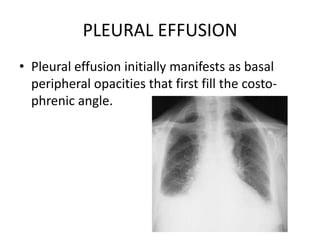PLEURAL EFFUSION
• Pleural effusion initially manifests as basal
  peripheral opacities that first fill the costo-
  phrenic angle.
 