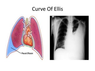 Curve Of Ellis
 