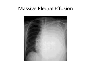 Massive Pleural Effusion
 
