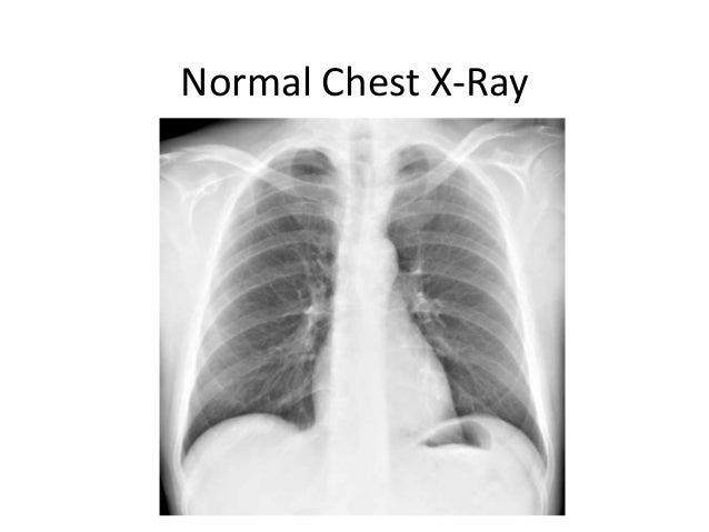 Chest x rays