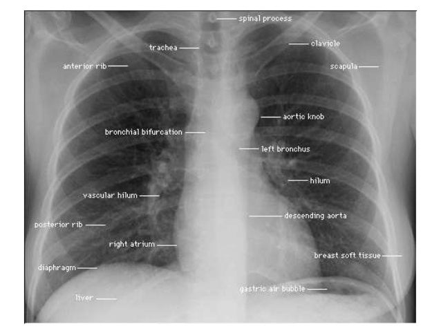 Chest x rays