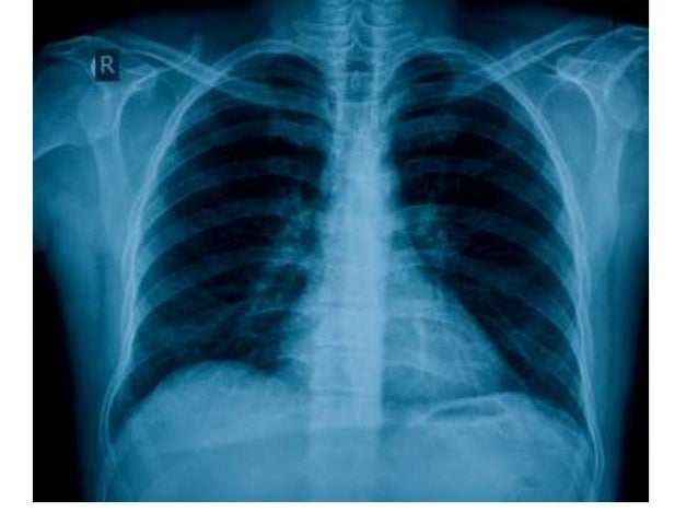 Chest X Rays