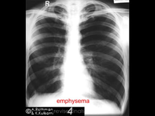 emphysema
 
