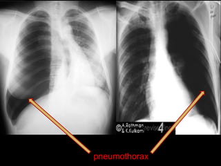 pneumothorax
 