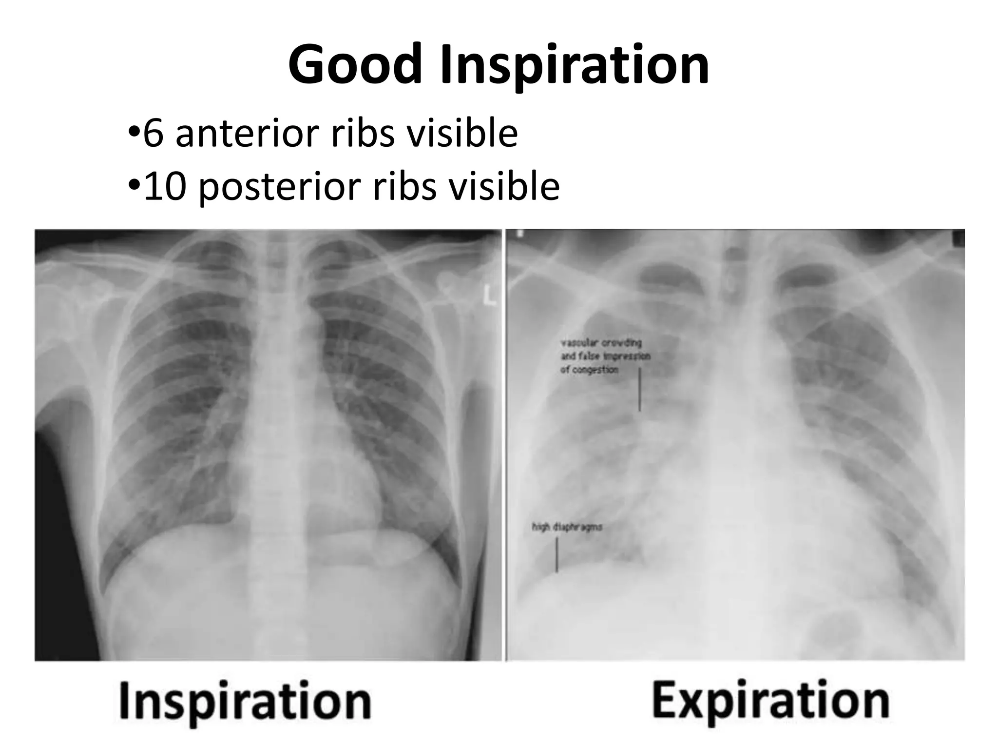 Inspiration Normal Ribs Chest X-rays for Undergraduates | PPTX