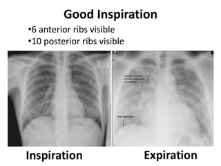 Good Inspiration
•6 anterior ribs visible
•10 posterior ribs visible
 