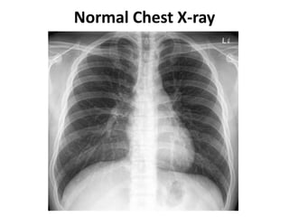 Normal Chest X-ray
 