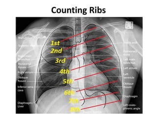 Counting Ribs
 