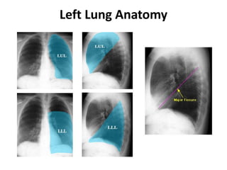 Left Lung Anatomy
 