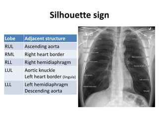 Silhouette sign
Lobe Adjacent structure
RUL Ascending aorta
RML Right heart border
RLL Right hemidiaphragm
LUL Aortic knuckle
Left heart border (lingula)
LLL Left hemidiaphragm
Descending aorta
 