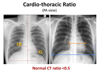 Cardio-thoracic Ratio
(PA view)
Normal CT ratio <0.5
 