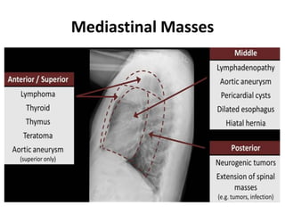 Mediastinal Masses
 