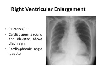 Right Ventricular Enlargement
• CT ratio >0.5
• Cardiac apex is round
and elevated above
diaphragm
• Cardio-phrenic angle
is acute
 