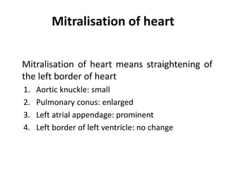 Mitralisation of heart
Mitralisation of heart means straightening of
the left border of heart
1. Aortic knuckle: small
2. Pulmonary conus: enlarged
3. Left atrial appendage: prominent
4. Left border of left ventricle: no change
 