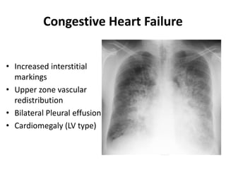 Congestive Heart Failure
• Increased interstitial
markings
• Upper zone vascular
redistribution
• Bilateral Pleural effusion
• Cardiomegaly (LV type)
 