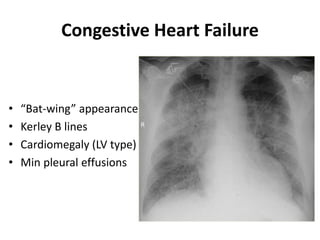 Congestive Heart Failure
• “Bat-wing” appearance
• Kerley B lines
• Cardiomegaly (LV type)
• Min pleural effusions
 