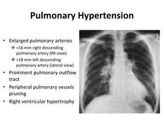 Pulmonary Hypertension
• Enlarged pulmonary arteries
 >16 mm right descending
pulmonary artery (PA view)
 >18 mm left descending
pulmonary artery (lateral view)
• Prominent pulmonary outflow
tract
• Peripheral pulmonary vessels
pruning
• Right ventricular hypertrophy
 