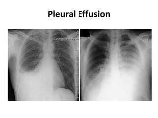 Pleural Effusion
 