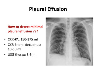 Pleural Effusion
How to detect minimal
pleural effusion ???
• CXR-PA: 150-175 ml
• CXR-lateral decubitus:
10-50 ml
• USG thorax: 3-5 ml
 