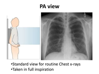 PA view
•Standard view for routine Chest x-rays
•Taken in full inspiration
 