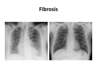Fibrosis
 