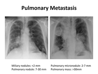 Pulmonary Metastasis
Miliary nodules: <2 mm Pulmonary micronodule: 2-7 mm
Pulmonary nodule: 7-30 mm Pulmonary mass: >30mm
 