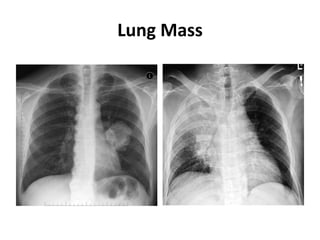 Lung Mass
 