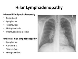 Hilar Lymphadenopathy
Bilateral hilar lymphadenopathy
• Sarcoidosis
• Lymphoma
• Tuberculosis
• Histoplasmosis
• Pnemuconiosis: silicosis
Unilateral hilar lymphadenopathy
• Lymphoma
• Carcinoma
• Tuberculosis
• Histoplasmosis
 
