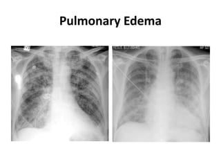 Pulmonary Edema
 