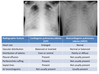 Radiographic feature Cardiogenic pulmonary edema
(LVF)
Noncardiogenic pulmonary
edema (ARDS)
Heart size Enlarged Nornal
Vascular distribution Balanced or inverted Normal or balanced
Distribution of edema Even or central Patchy or diffuse
Pleural effusion Present Not usually present
Peribronchila cuffing Present Not usually present
Septal lines Present Not usually present
Air bronchograms Not usually present Usually present
 