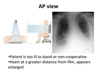 AP view
•Patient is too ill to stand or non-cooperative
•Heart at a greater distance from film, appears
enlarged
 