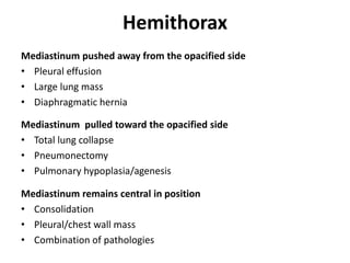 Hemithorax
Mediastinum pushed away from the opacified side
• Pleural effusion
• Large lung mass
• Diaphragmatic hernia
Mediastinum pulled toward the opacified side
• Total lung collapse
• Pneumonectomy
• Pulmonary hypoplasia/agenesis
Mediastinum remains central in position
• Consolidation
• Pleural/chest wall mass
• Combination of pathologies
 