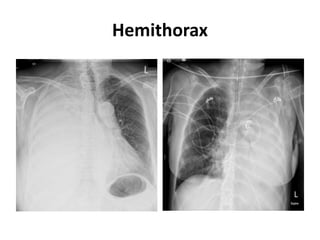 Hemithorax
 