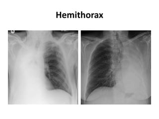 Hemithorax
 