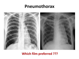 Pneumothorax
Which film preferred ???
 