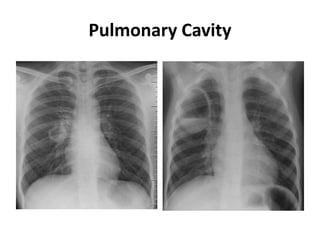 Pulmonary Cavity
 
