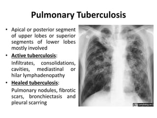 Pulmonary Tuberculosis
• Apical or posterior segment
of upper lobes or superior
segments of lower lobes
mostly involved
• Active tuberculosis:
Infiltrates, consolidations,
cavities, mediastinal or
hilar lymphadenopathy
• Healed tuberculosis:
Pulmonary nodules, fibrotic
scars, bronchiectasis and
pleural scarring
 
