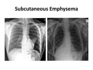 Subcutaneous Emphysema
 