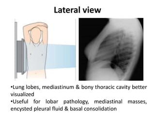 Lateral view
•Lung lobes, mediastinum & bony thoracic cavity better
visualized
•Useful for lobar pathology, mediastinal masses,
encysted pleural fluid & basal consolidation
 