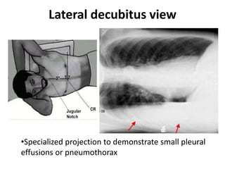 Lateral decubitus view
•Specialized projection to demonstrate small pleural
effusions or pneumothorax
 