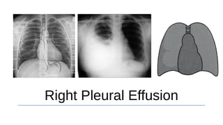 Right Pleural Effusion
 
