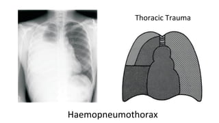 Thoracic Trauma
Haemopneumothorax
 