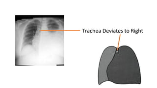 Trachea Deviates to Right
 