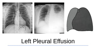Left Pleural Effusion
 