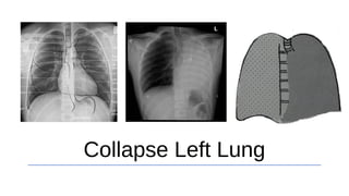 Collapse Left Lung
 