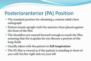 Chest x ray | PPTX