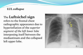 Luftcycle Sign Chest x ray | PPTX
