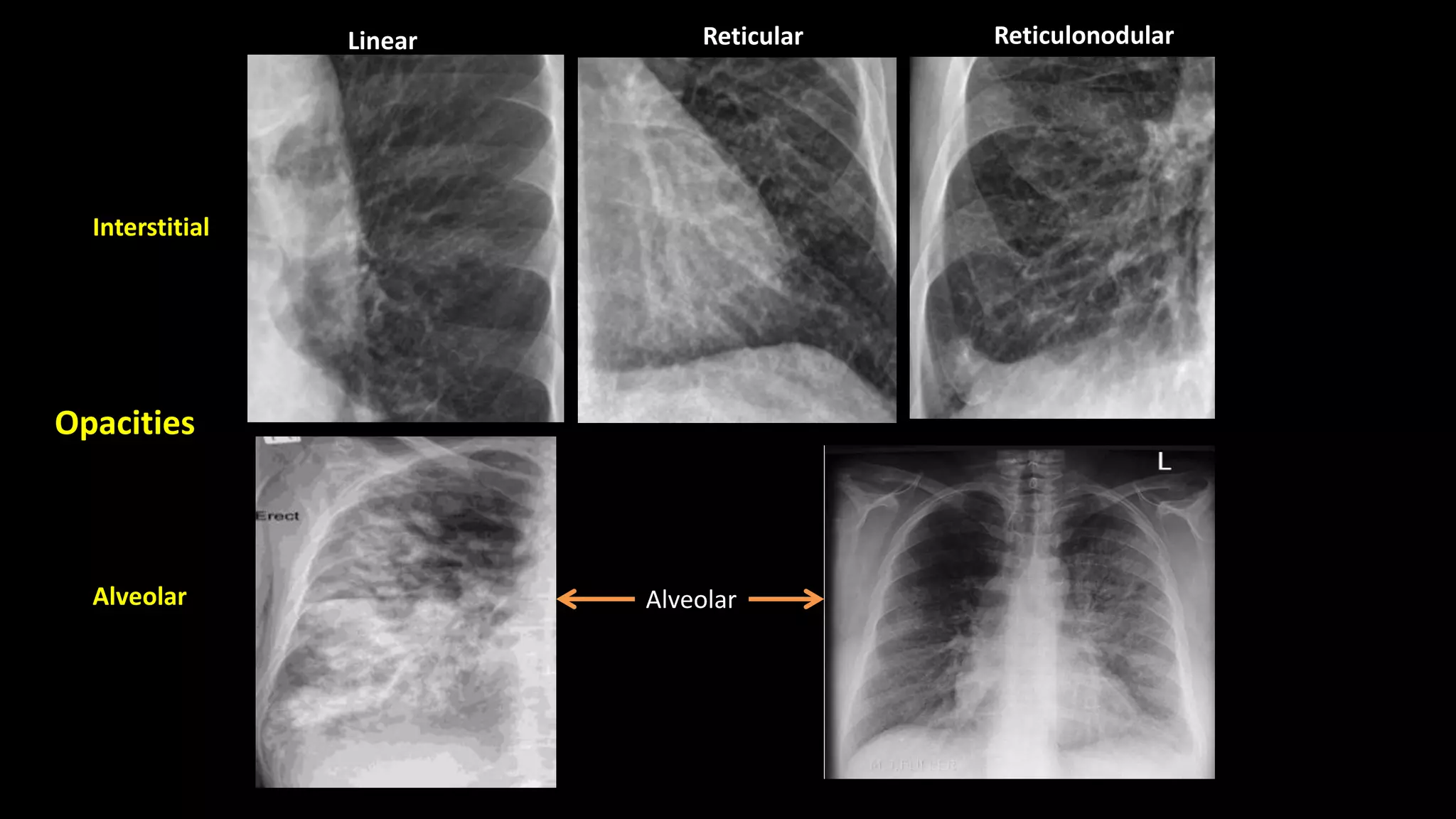 Chest X-ray Basics and Interpretation | PPTX