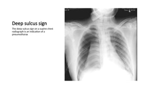 Chest x-ray INTERPRETATION AND signs.pptx